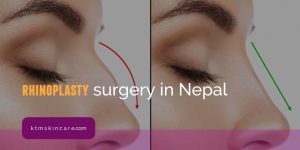Rhinoplasty Treatment In Nepal