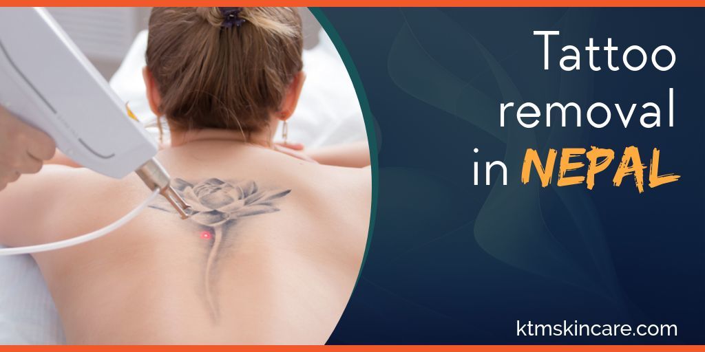 Tattoo Removal In Nepal